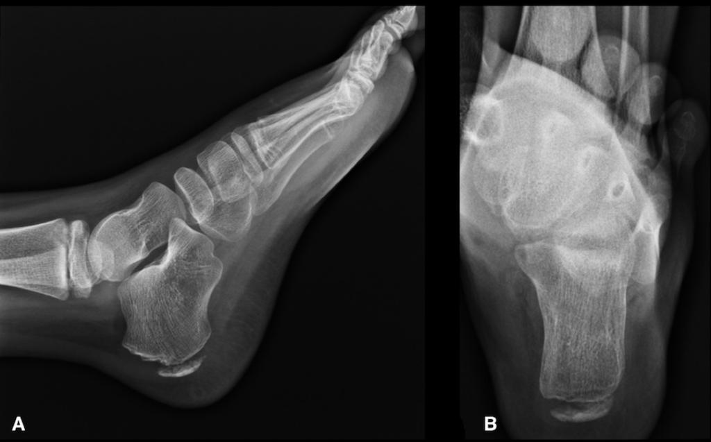 Fig. 7: Calcaneal radiograph, A) lateral and B) axial view, the feet bones show normal appearance in 7 years