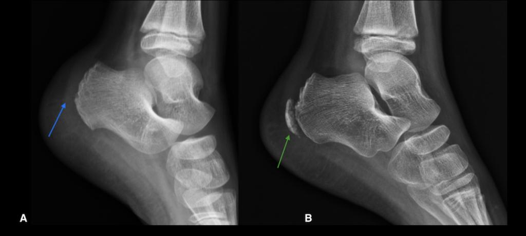 Fig. 2: Foot radiograph lateral view. A) New born and B) 2 years boy, shows ossified calcaneus (white arrow), the calcaneal apophysis is not visualized (yellow dot lines). Fig.
