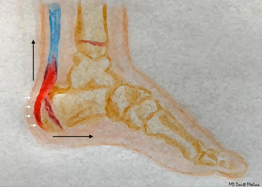 Fig. 5: Drawing of the lateral view of the foot, demonstrates the tensil forces of the