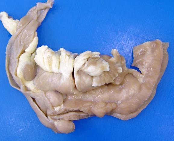 Pathology of the Alimentary Tract Case 4