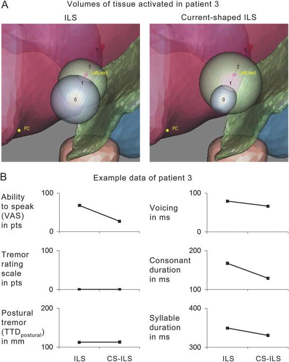 Individualized currentshaping reduces DBSinduced dysarthria in patients with essential tremor (Barbeet al, 2014) Electrode localization of one patient with exemplary tremor and speech