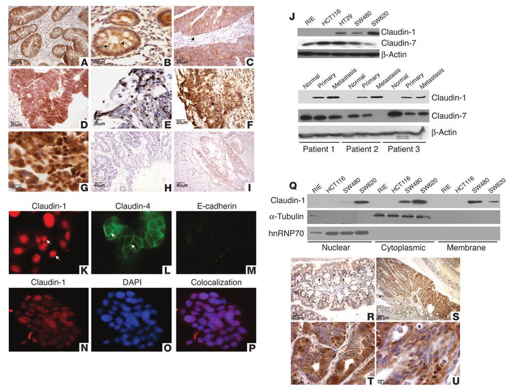 Figure 1 Claudin-1 expression increases in colon carcinoma and metastasis.