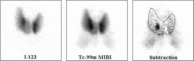 The subtraction scan confirms this site of abnormality. The second patient (B) has an ectopic gland below the left lobe of the thyroid. confidence intervals) for solitary adenomas were 88.44 (87.