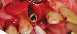 Othman Shibly et al: Buccal Bone Regeneration at Implants 67 At one-year re-entry, all peri-implant gaps assessed from the internal socket wall to the implant surface were healed and the horizontal