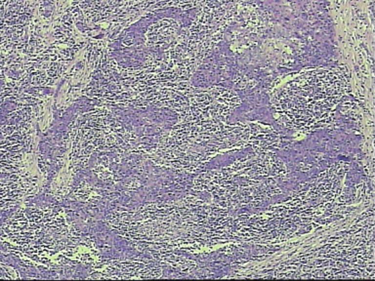 Journal of Thoracic Disease, Vol 7, No 12 December 215 2331 Introduction Lymphoepithelioma-like carcinoma (LELC) is one of the uncommon histological types of cancer.