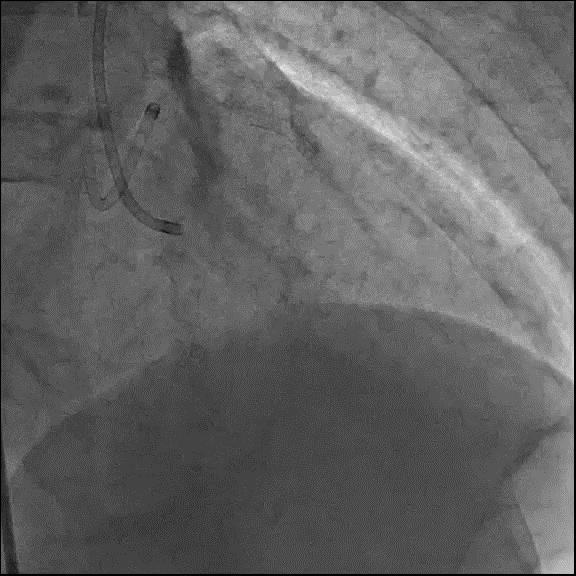 LAD proximal CTO case in CCT2015 Jailed CTO entry point by previously