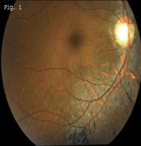 neuritis, glaucoma, cataract, and/or retinal vasculitis.