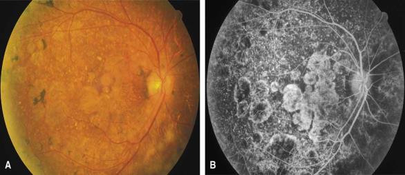` Treatment Options IV Penicillin Patients with ocular syphilis should undergo CSF testing and, regardless of findings, be treated as neurosyphilis with 10 to 14 days of high-dose intravenous