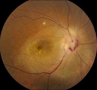 Cat Scratch Disease Signs: granulomatous conjunctivitis with pre-auricular lymphadenopathy systemic lymphadenopathy optic nerve edema
