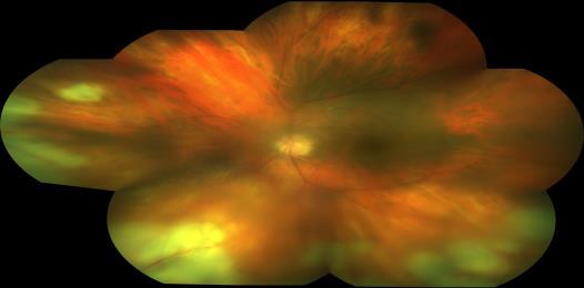 Acute Retinal Necrosis Treatment options Intravenous acyclovir/valacyclovir /famciclovir in conjucntion with oral Intravitreals For anterior segment inflammation: Cycloplegic with topical steroid