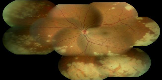 . Symptoms Location Differentiating the Herpetic Retinopathies PORN ARN CMV Floaters, VA loss, peripheral constriction, no pain Peripheral Hazy vision,
