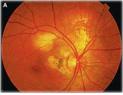 Fundus findings in tuberculosis can be divided into four groups: Choroidal tubercules: small inflammatory nodule that forms when the immune system builds a wall around the TB Choroidal tuberucloma: