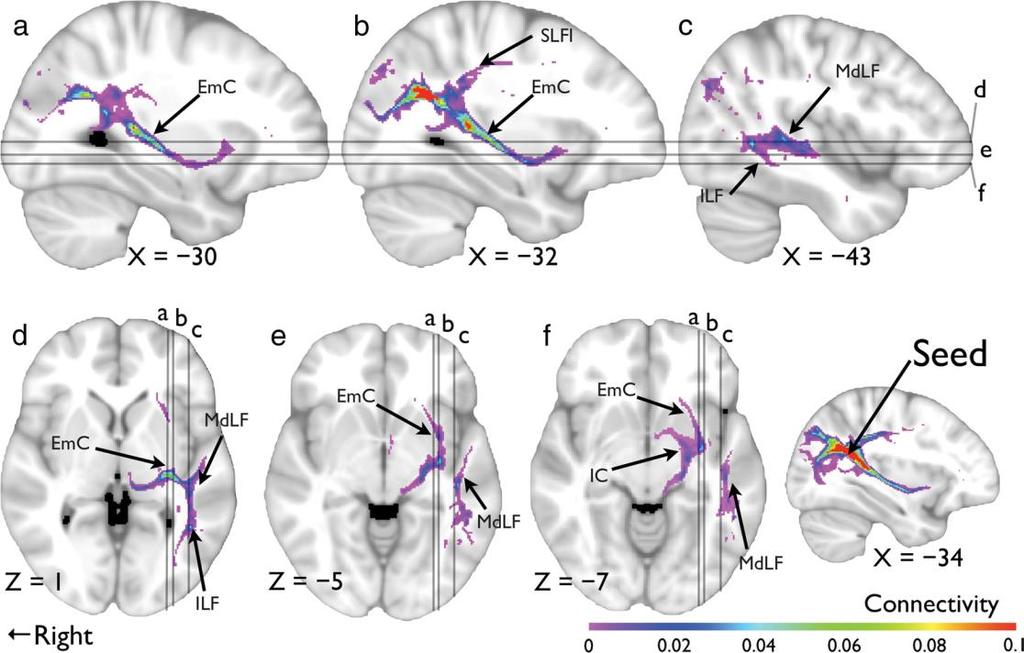 White matter anisotropy in the ventral language pathway predicts sound-to-word learning success Wong, F. C., Chandrasekaran, B., Garibaldi, K., & Wong, P.