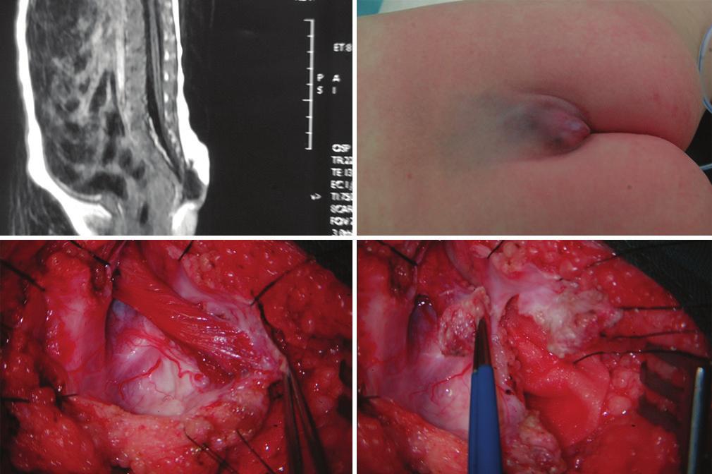 SNI: Peditric Neurosurgery 2015, Vol 6: Suppl 11 - A Supplement to Surgicl Neurology Interntionl In ptients with lipomyelomeningocele, fter the cyst is seprted, most of the time, hlf of the lmine of