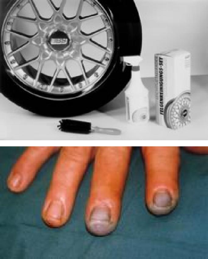 This can lead to loss of fingers No symptoms paresthesia severe pain without visible lesions necrosis Systemical