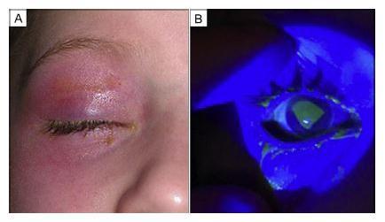 ward On admission: erythema on right cheek, swollen eyelid (upper right) and red conjunctiva