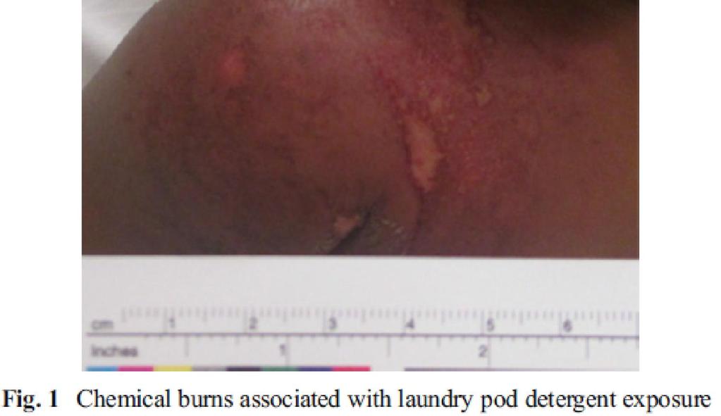 burns associated with dermal exposure to laundry pod