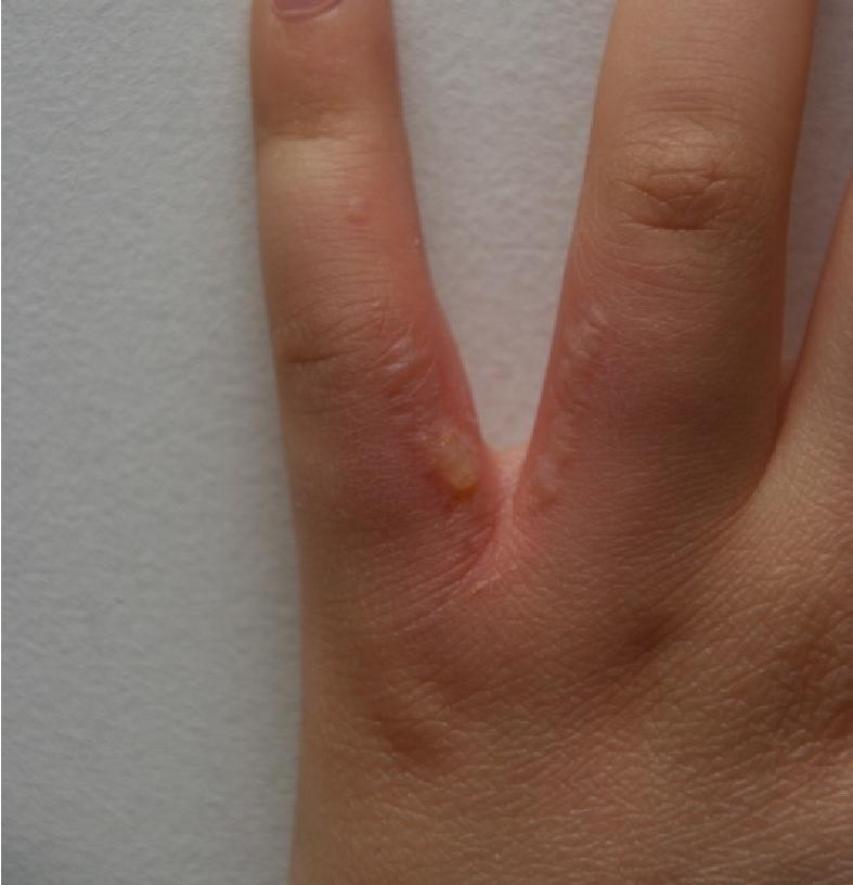 Skin itches /aches - Next morning: red skin between fingers -