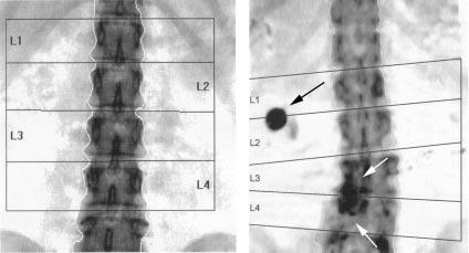 DXA of the lumbar spine: Good scan Problem scan FIGURE 2. Left, normal positioning for dual-energy x-ray absorptiometry (DXA) of the lumbar spine.