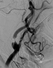 Carotid Stenosis Accounts for ~20% of ischemic strokes Carotid endarterectomy: Has been around since 1953 Carotid stenting: < 20 years Don t forget the importance of medical management Asymptomatic