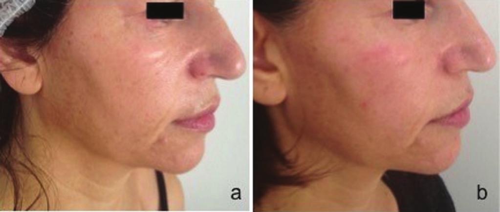 who also reported photosensitivity. Two patients reported a decrease in facial fat tissue at the 6th month evaluation. Figure 4.