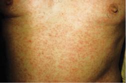 Morbilliform drug eruption common erythematous macules, papules (can be confluent) pruritus no systemic symptoms begins in 1 st or 2nd week treatment: -D/C med if severe -symptomatic treatment: