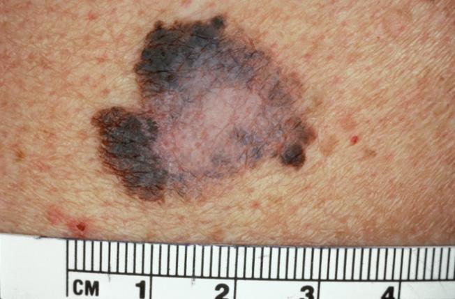 ALT, AST Transaminitis Drug-induced hypersensitivity syndrome BUN, Cr Acute renal failure Drug-induced hypersensitivity syndrome, AGEP Patient returns with a changing mole Spots, skin cancers,