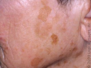 extremities > face do not progress to malignancy stuck-on tan,