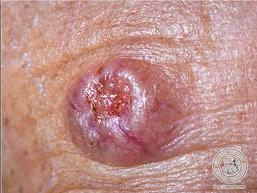 Basal cell carcinoma pearly papule or plaque - central ulceration - telangiectasia slow