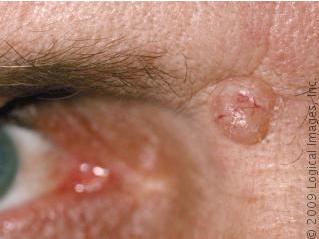 carcinoma scaly erythematous plaque to nodule sun exposed area potential to metastasize Rx: