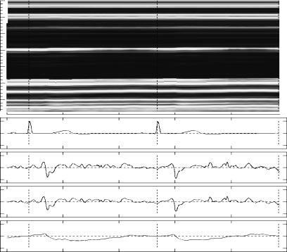 Jpn. J. Appl. Phys., Vol. 44, No. 8 (25) M. SUGIMOTO et al. 6299 5. mm depth x in (t) x min (t) 3 25 2 15 1 1. mm/s (c) 5 1. 1. mm/s 1. 2 µm 2 1 2 (d) (e).3.2.1 Fig. 3. M-mode image of brachial artery (24-year-old male).
