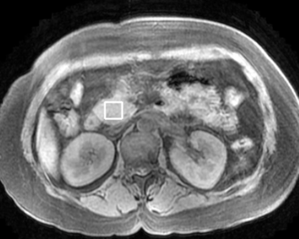Fig. 4: The location image of Figure 3 in T1WI illustrated the enlargement of pancreatic head, and