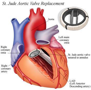 Surgical Aortic Valve Replacement Surgical aortic valve replacement (AVR) is the standard treatment for patients with
