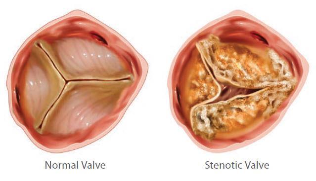 AS occurs when the heart valve essentially becomes like a stiff door, not allowing the