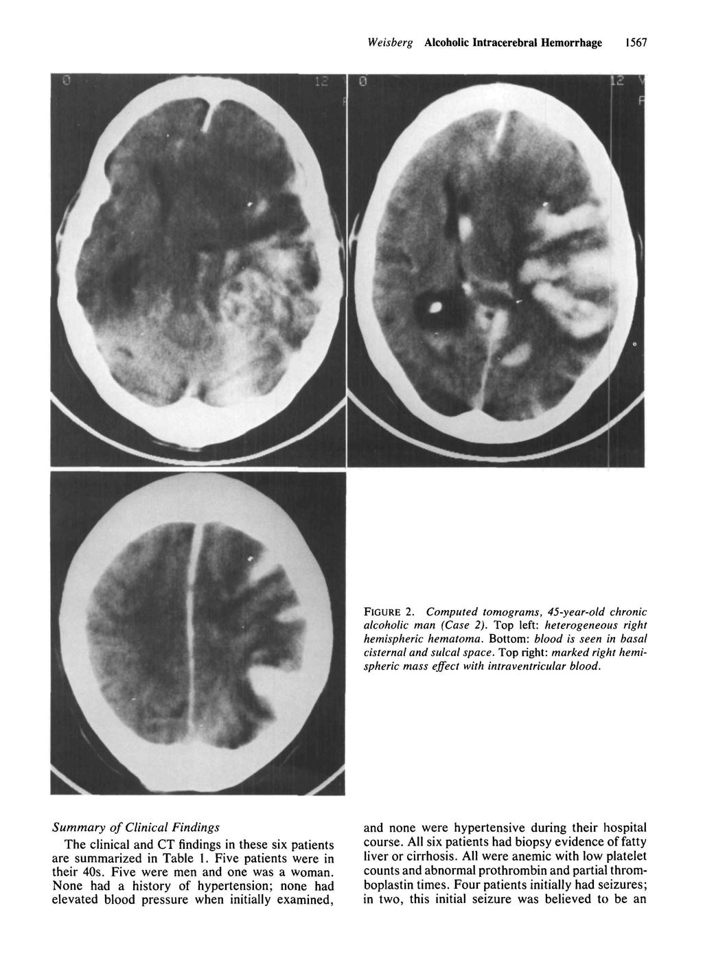 Weisberg Alcoholic Intracerebral Hemorrhage 1567 FIGURE 2. Computed tomograms, 45-year-old chronic alcoholic man (Case 2). Top left: heterogeneous right hemispheric hematoma.