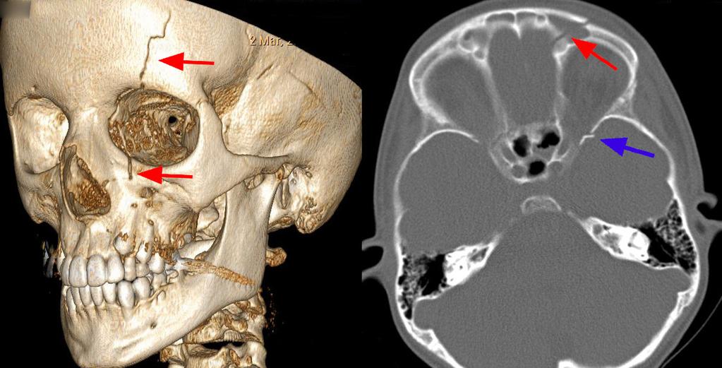 13: Twelve year old girl with head injury and left frontal bone fracture with
