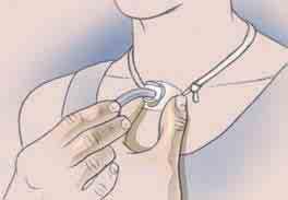 Lean your head back. Use your fingers to spread your stoma open. Using the obturator, slide the outer cannula back into your stoma.
