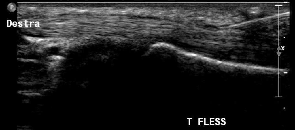 Fig. 9: US puncture of the tendon sheath