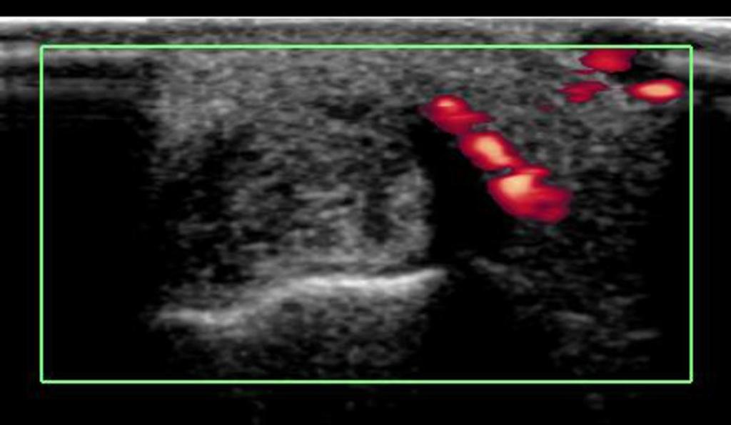 Fig. 5: US axial scan show increase of intra-articular power