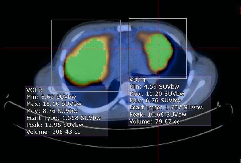 In each ROI, voxels presenting a threshold of 41% SUVmax were incorporated to define tumor