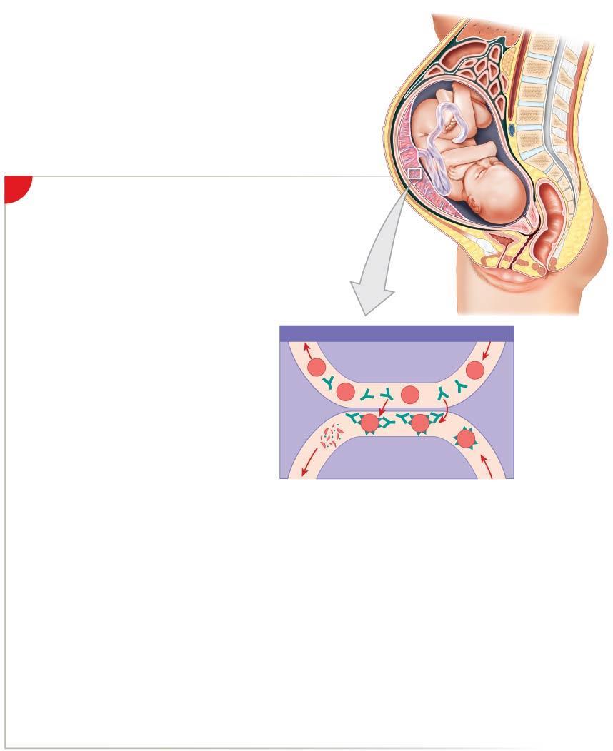 Figure 19-8 Hemolytic Disease of the Newborn (Part 6 of 6).