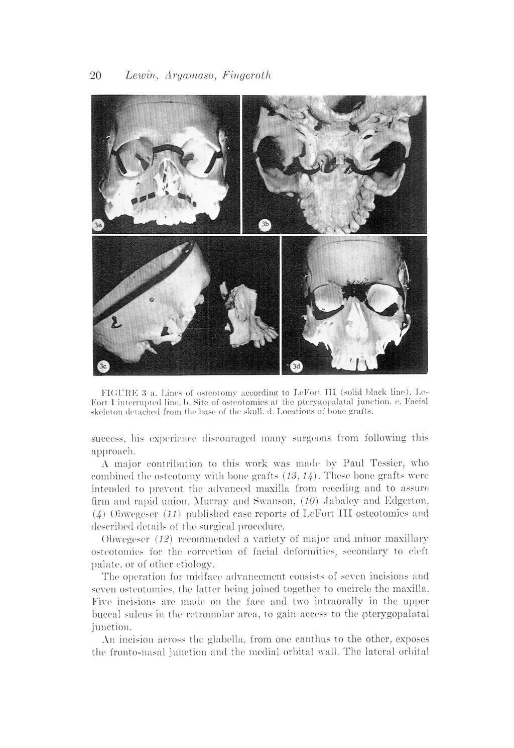 20 Lewin, Argamaso, Fingeroth FIGURE 3 a. Lincs of osteotomy according to LeFort: TII (solid black linc), LeFort 1 interrupted line. b. Site of osteotomies at the pterygopalatal junction. c.