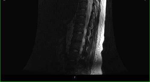 the following three features: (1) Myelitis which is longitudinally extensive (LETM), spanning three or more vertebral