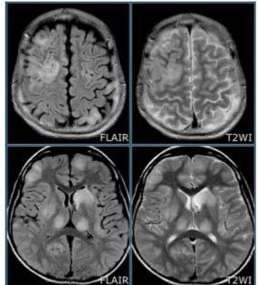 Acute Disseminated Encephalomyelitis (ADEM) In addition to autoimmune disease, some researchers also have reported patients with Zika infections developing encephalitis and myelitis nerve disorders