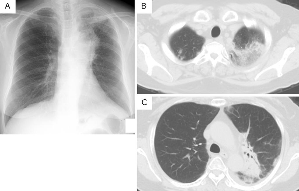 (A) Chest X-ray on admission showed consolidation within the irradiated lung field and ground-glass opacity in the left upper lung field.