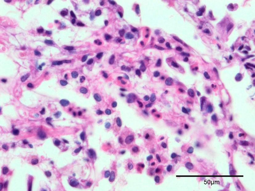 A histological examination by a transbronchial lung biopsy from the left upper lobe revealed increased eosinophils in the terminal bronchioles and alveoli with no fibrotic changes (Hematoxylin and