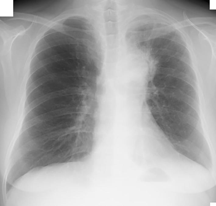 Figure 6. Chest X-ray one month after the discontinuation of steroids showed relapse of ground-glass opacity in the left upper lung field.