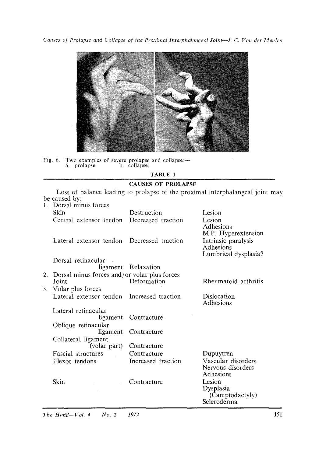 Causes of Prolapse and Collapse of the Pro.cimallnterphalangeal Joint-!. C. VanderMeulen Fig. 6. Two examples of severe prolapse and collapse: