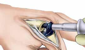 Step 10 Trial Insertion and Reduction 10-1 Broaching is complete when both sides have been broached to equal sizes in the distal and proximal ends. Flex the joint. Insert the Distal Trial.