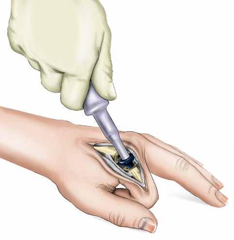 Gently impact the Proximal Trial with the Proximal Impactor until the collar of the trial seats against the metacarpal osteotomy.